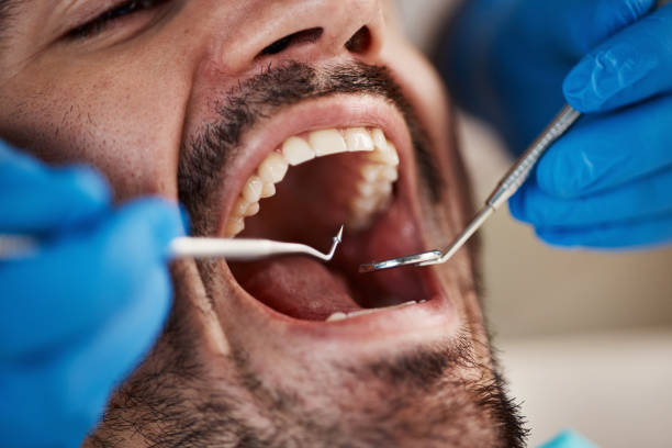 Best Chipped Tooth Repair Near Me  in Ucon, ID